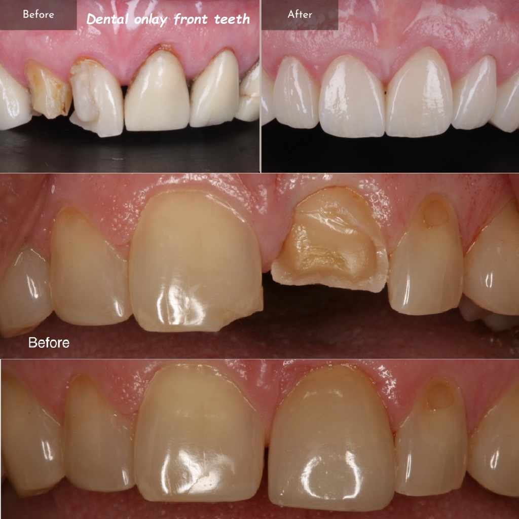 Dental onlay front teeth