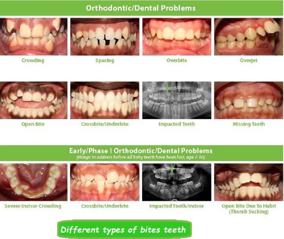 different types of bites teeth