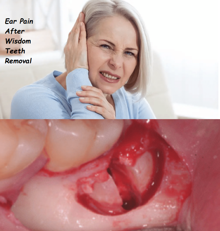 Ear pain from wisdom teeth removal