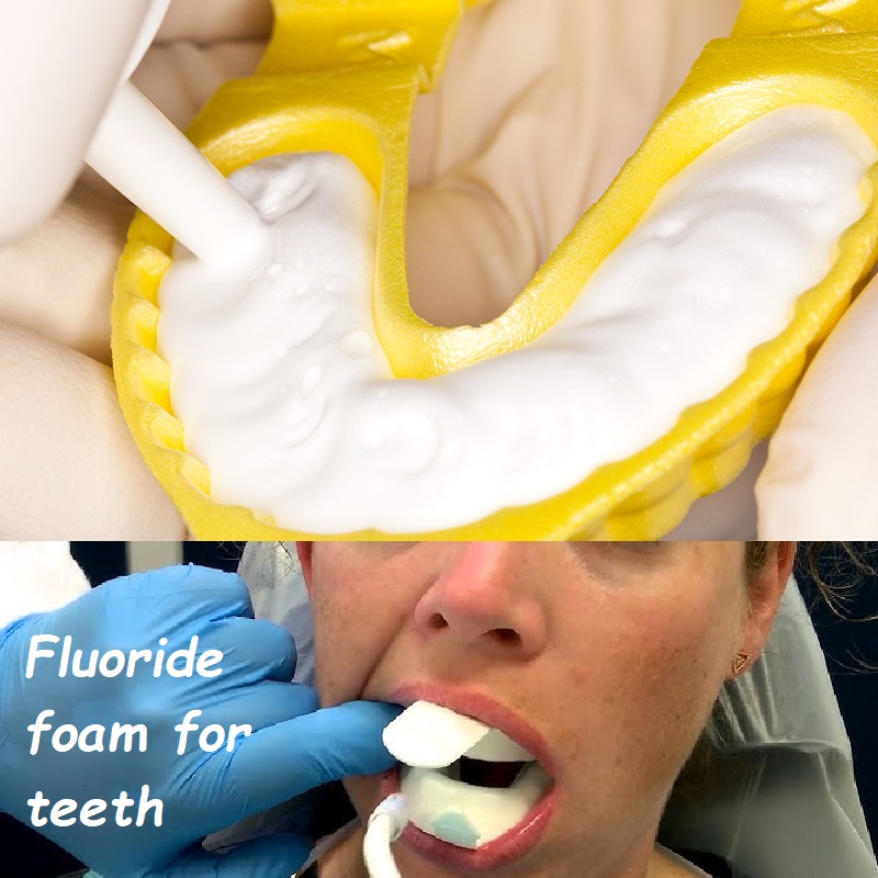 Fluoride foam for teeth