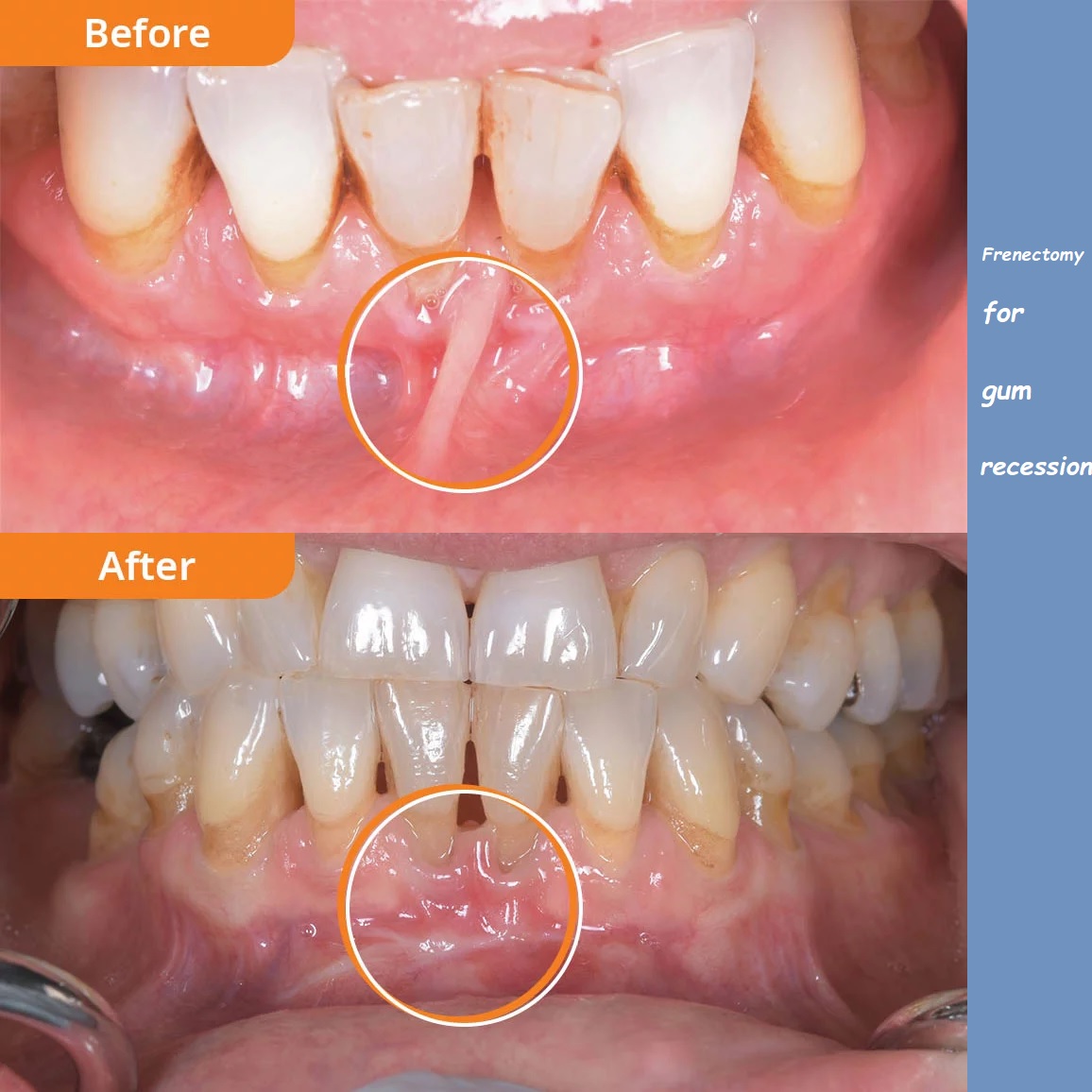 Frenectomy for gum recession