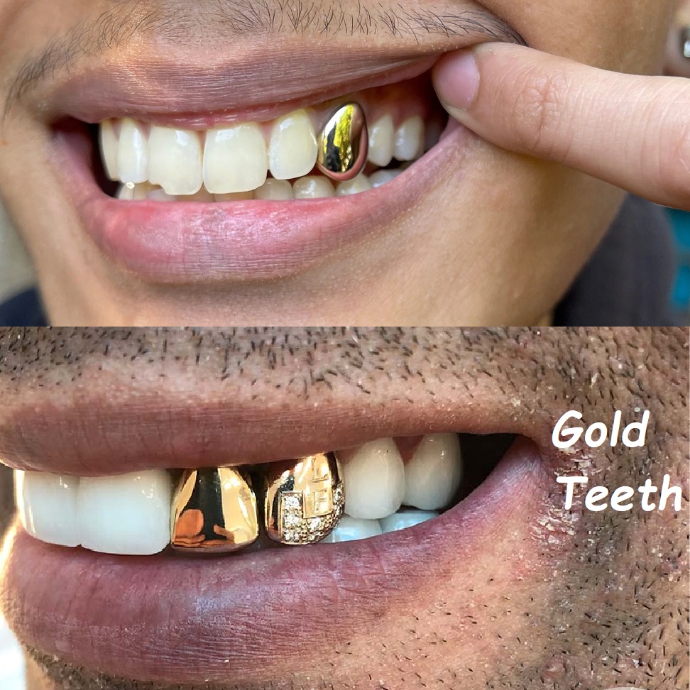 Gold Teeth Types, Care, and Modern Trends