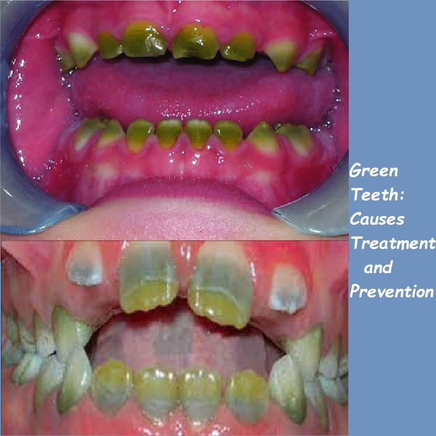 Green Teeth: Causes, Treatment, and Prevention