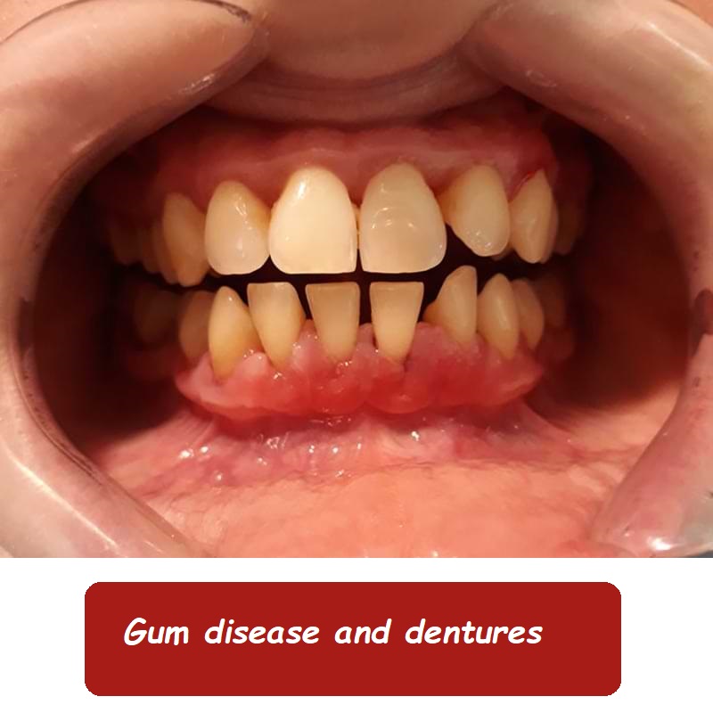 Gum disease and dentures