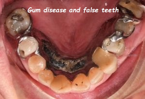 Gum disease and false teeth