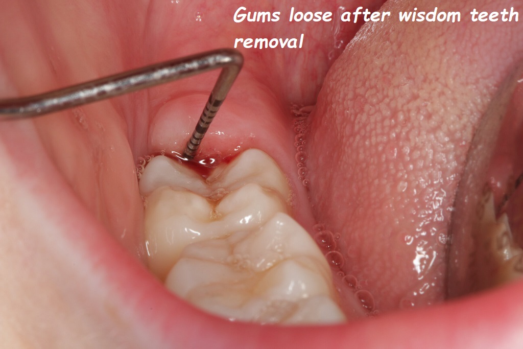 Gums loose after wisdom teeth removal