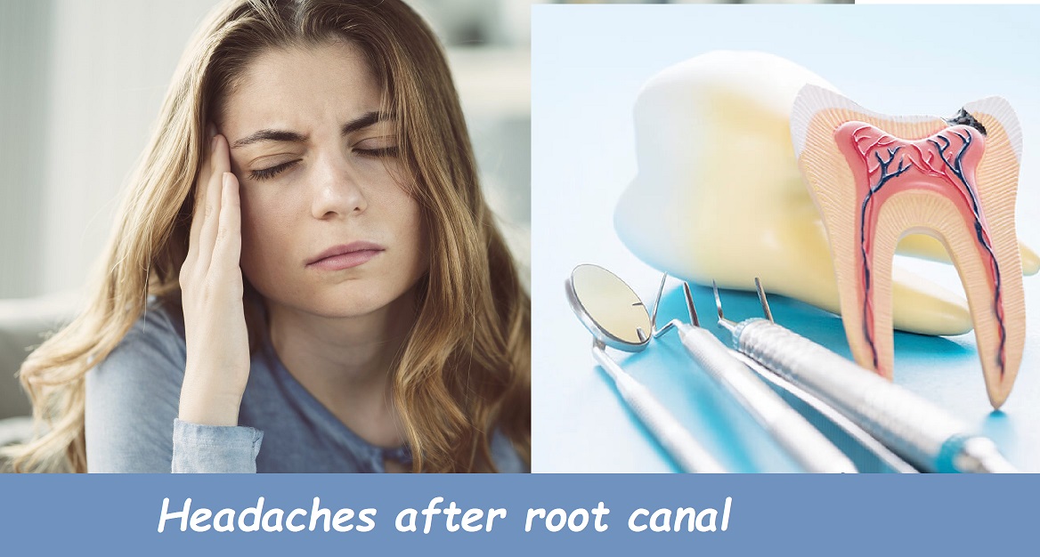 Headaches after root canal