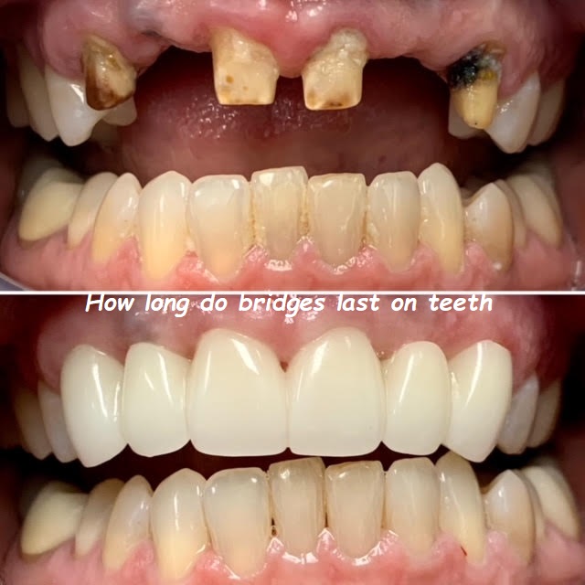 How long do bridges last on teeth