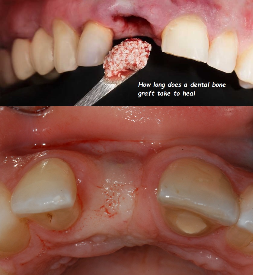 How long does a dental bone graft take to heal