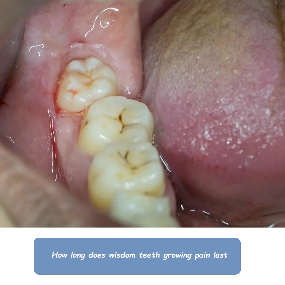 How long does wisdom teeth growing pain last