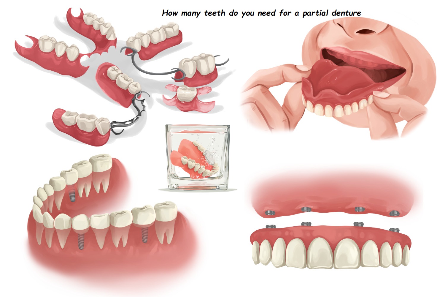 How many teeth do you need for a partial denture