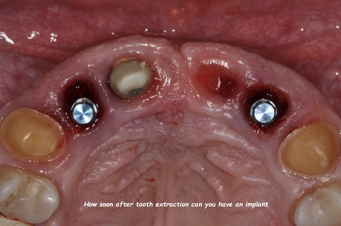 How soon after tooth extraction can you have an implant