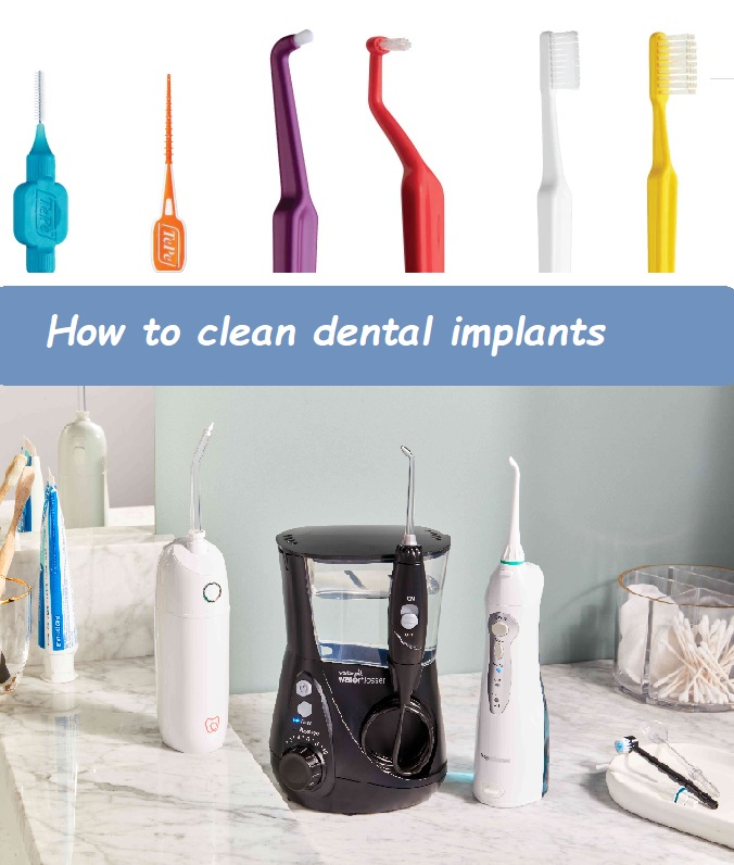 How to clean dental implants