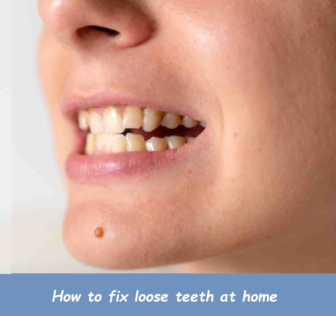 How to fix loose teeth at home