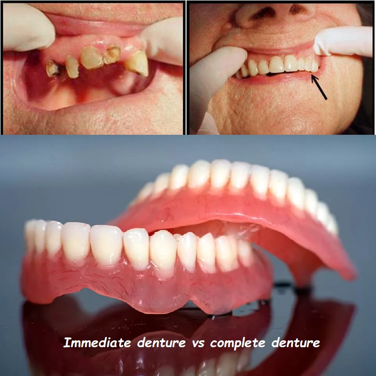 Immediate denture vs complete denture