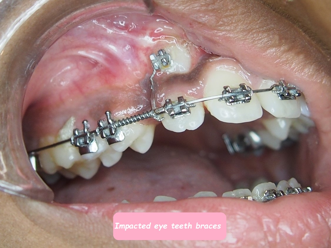 Impacted eye teeth braces