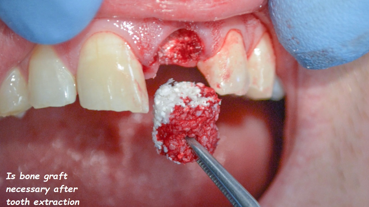 Is bone graft necessary after tooth extraction