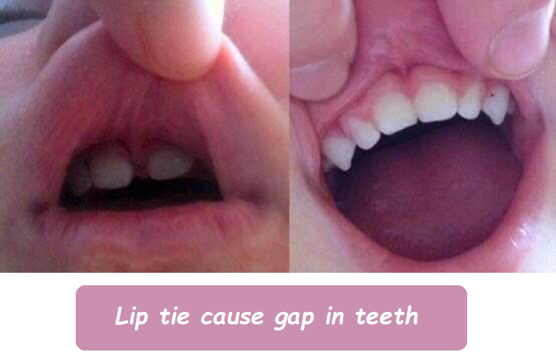 Lip tie cause gap in teeth