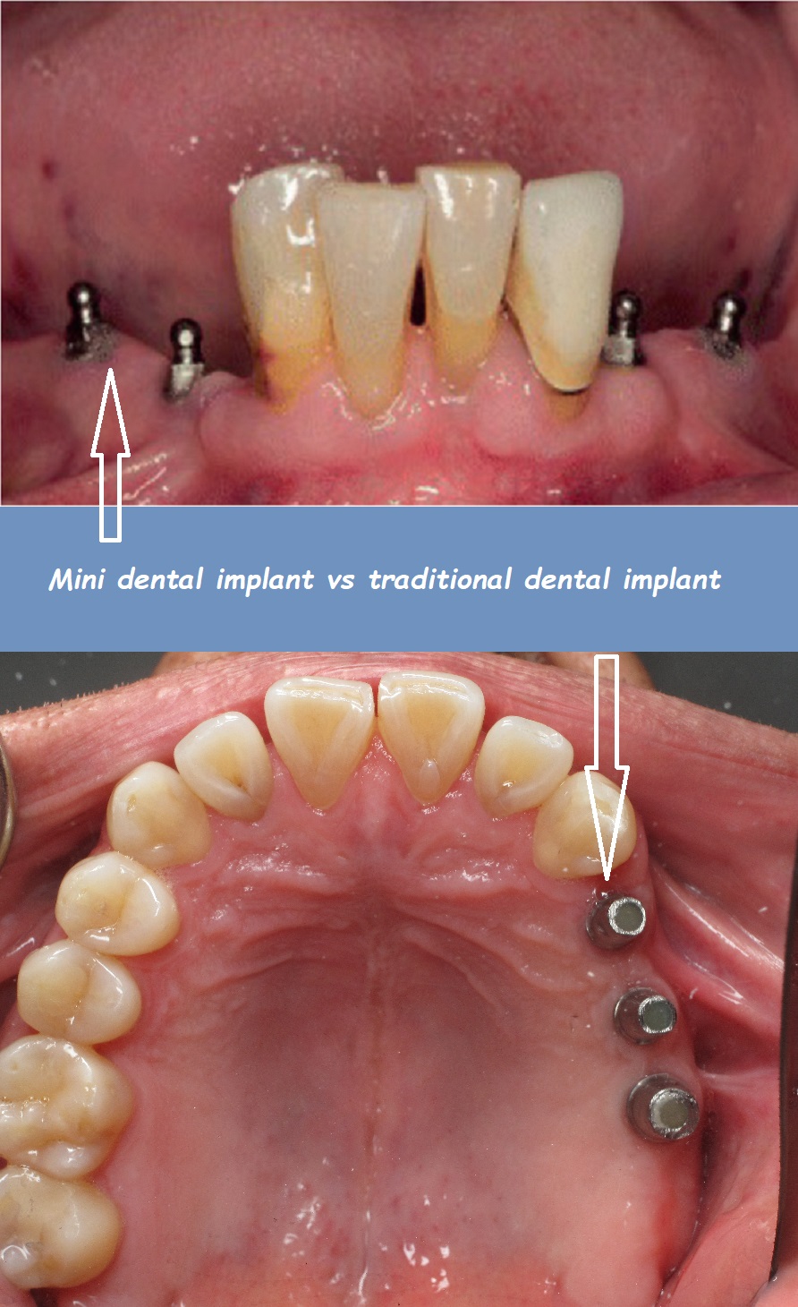 Mini dental implant vs traditional dental implant