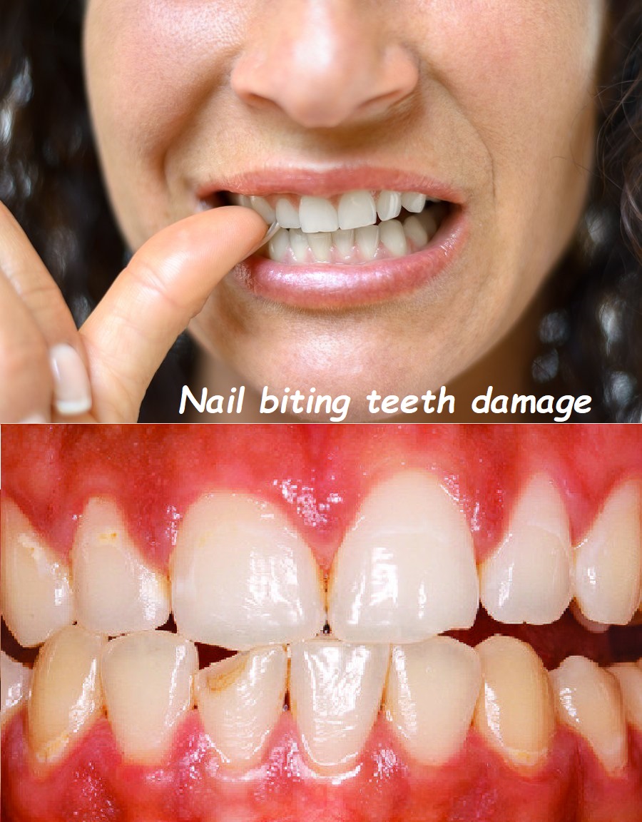 Nail biting teeth damage