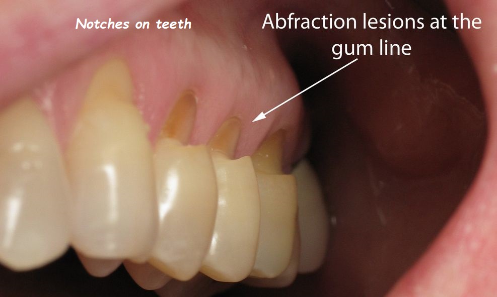 Notches on teeth