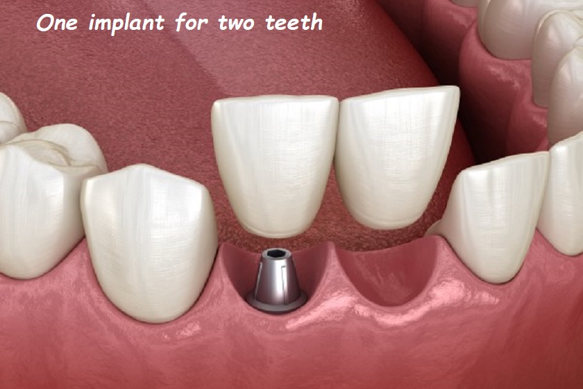 one implant for two teeth