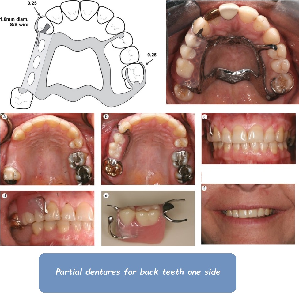 Partial dentures for back teeth one side