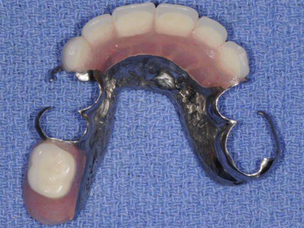 Partial dentures for front teeth