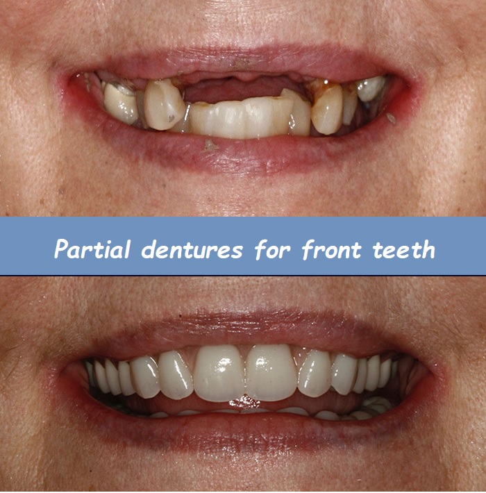 Partial dentures for front teeth