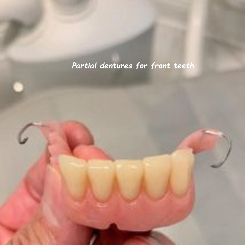 Partial dentures for front teeth