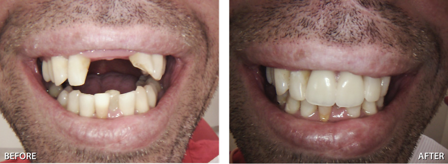 Partial dentures for front teeth