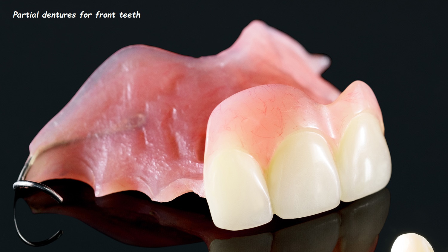 Partial dentures for front teeth