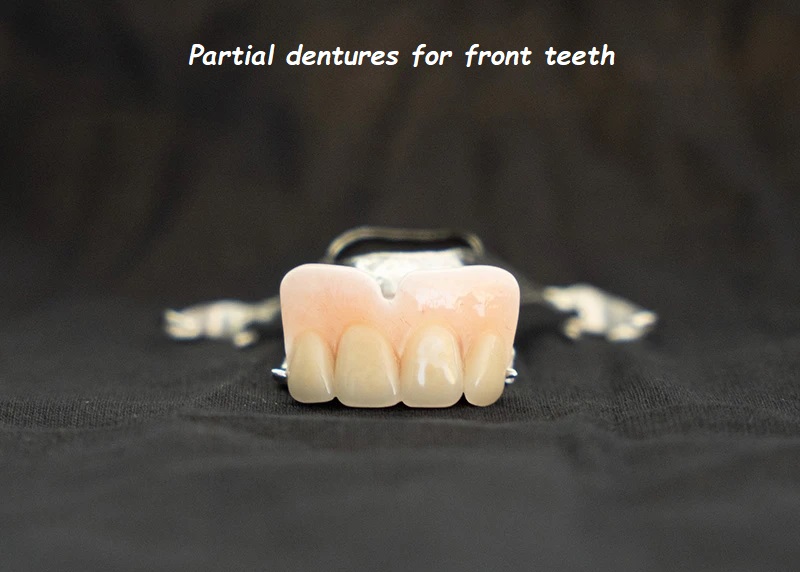 Partial dentures for front teeth