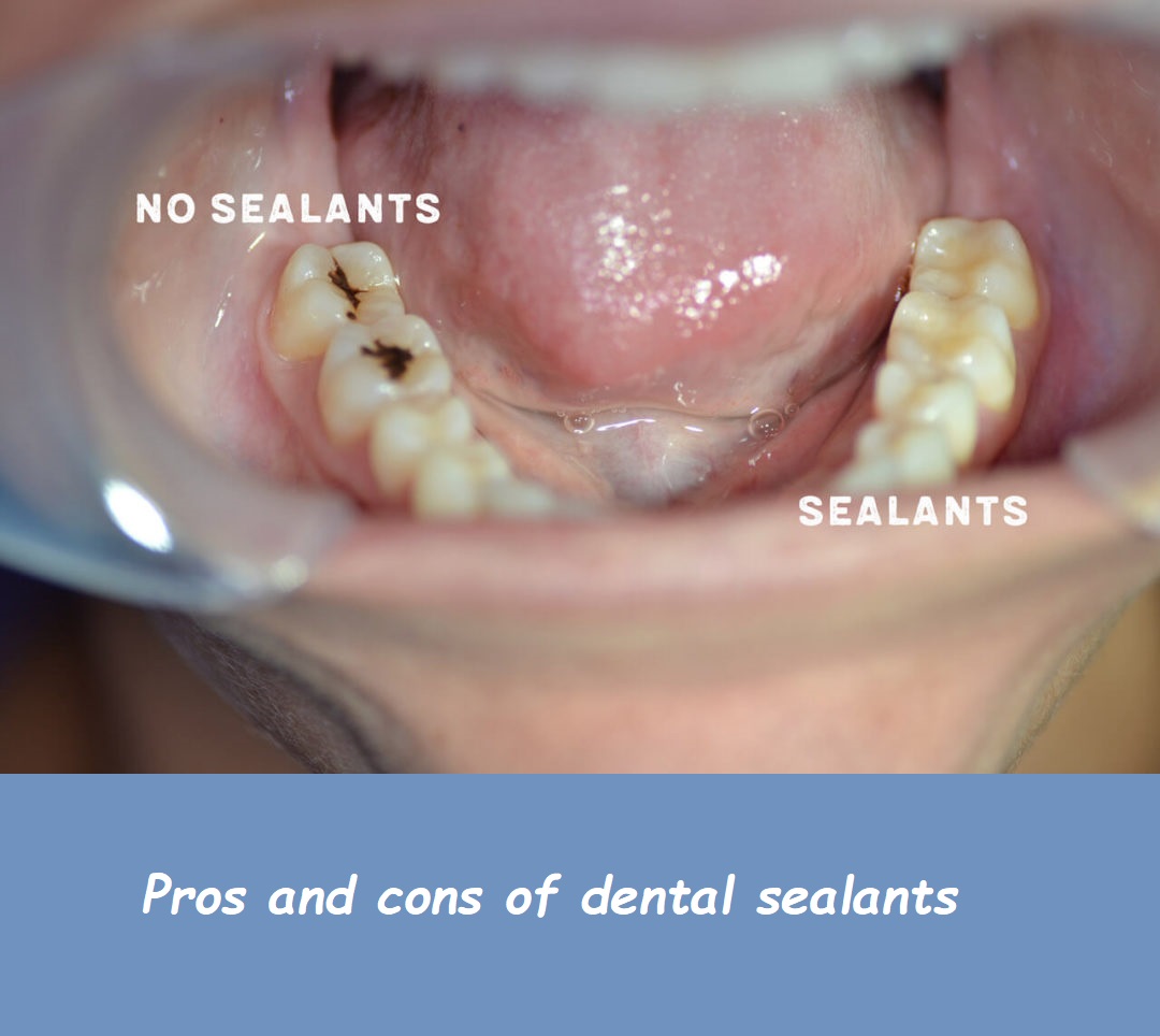 pros and cons of dental sealants