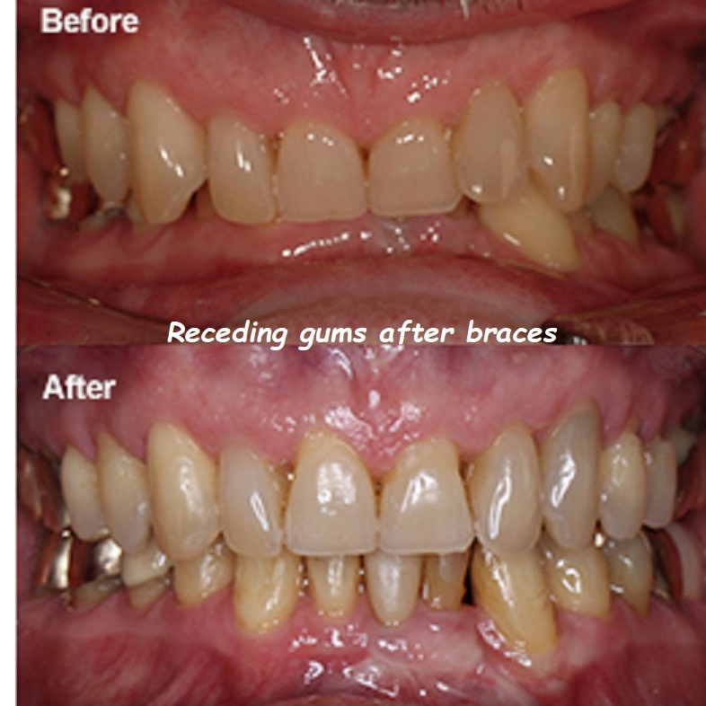 Receding gums after braces