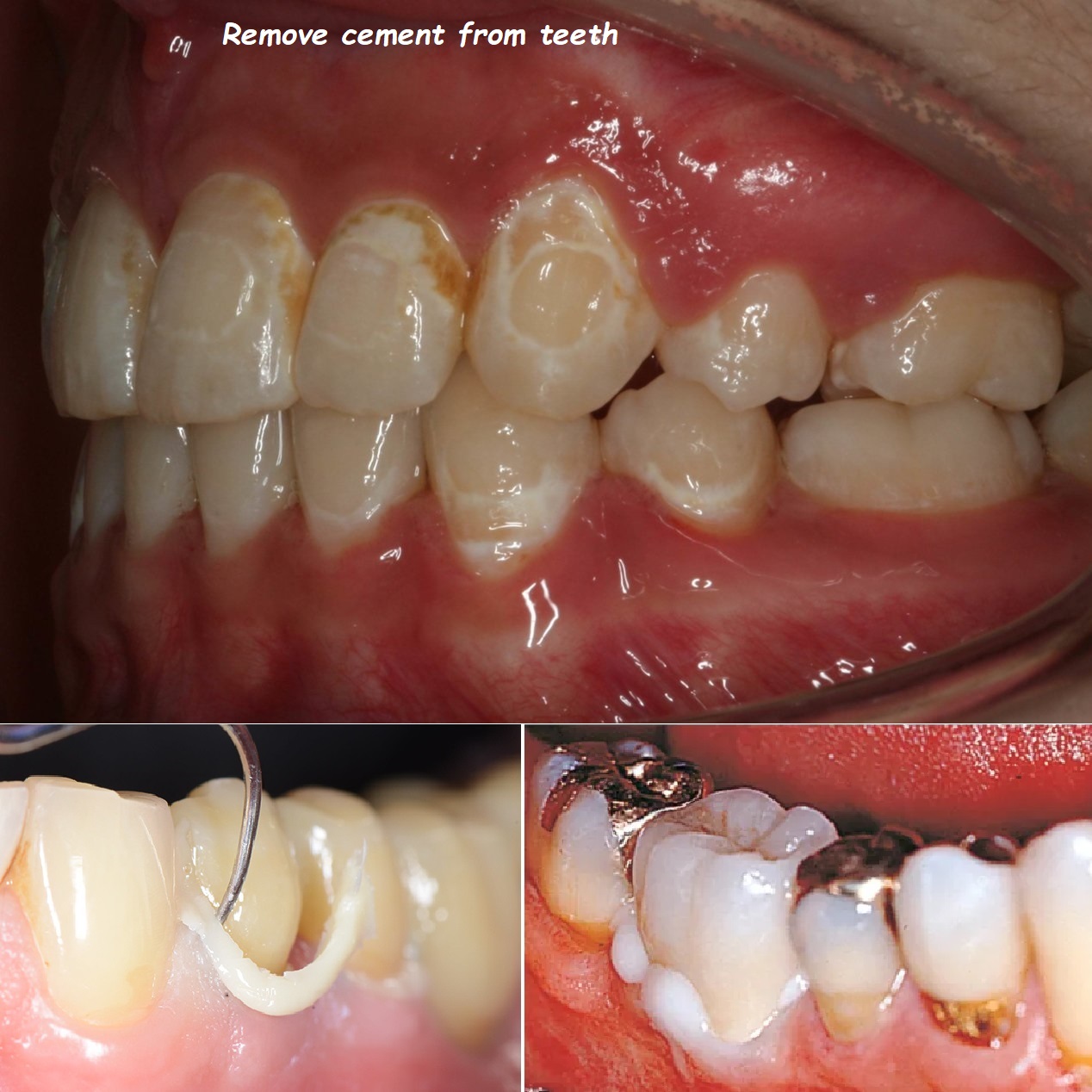 Remove cement from teeth