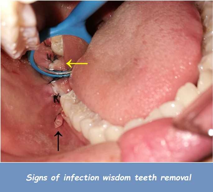 Signs of infection wisdom teeth removal