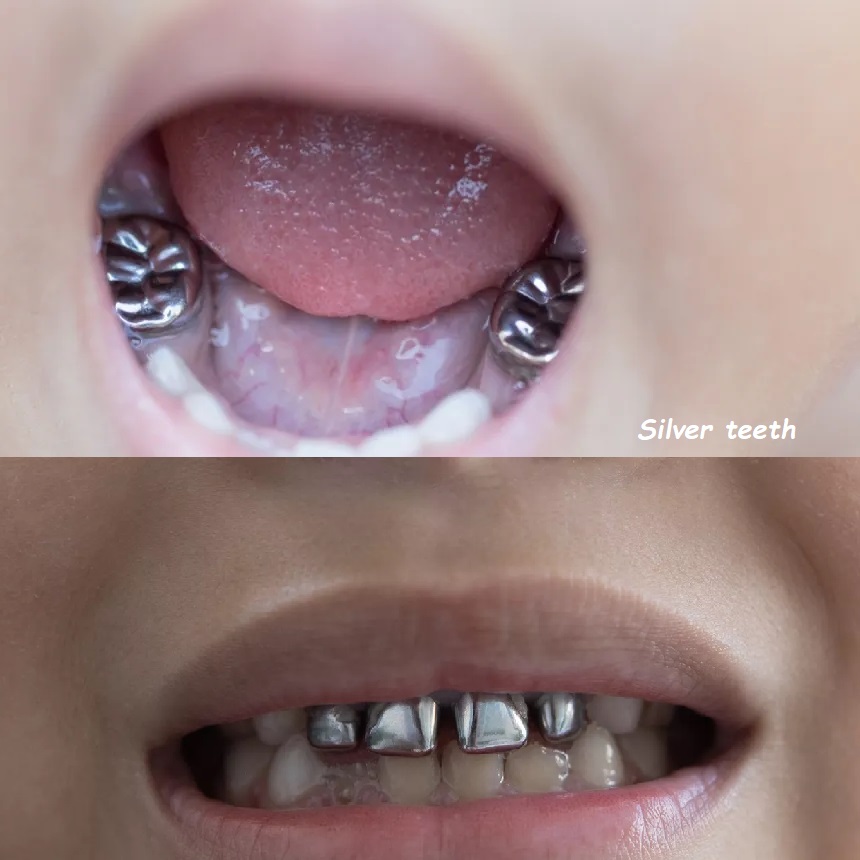 Silver teeth