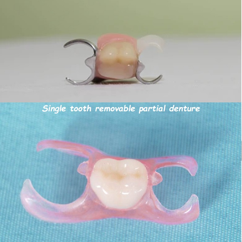 Single tooth removable partial denture