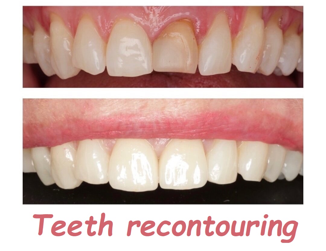 Teeth recontouring