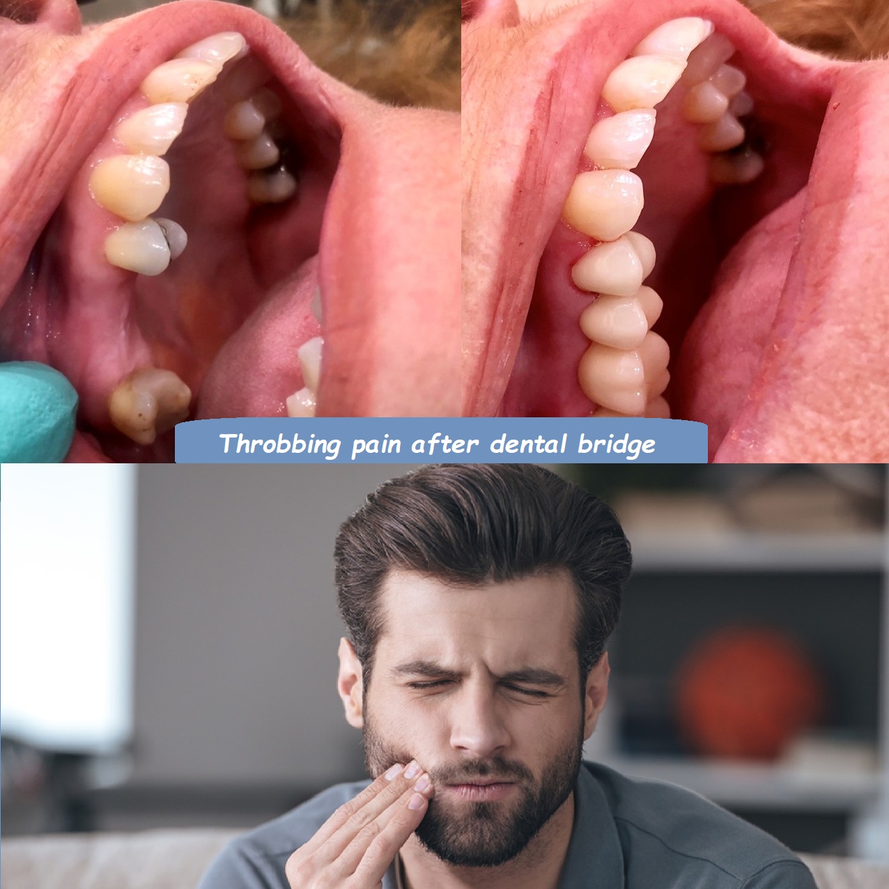 Throbbing pain after dental bridge