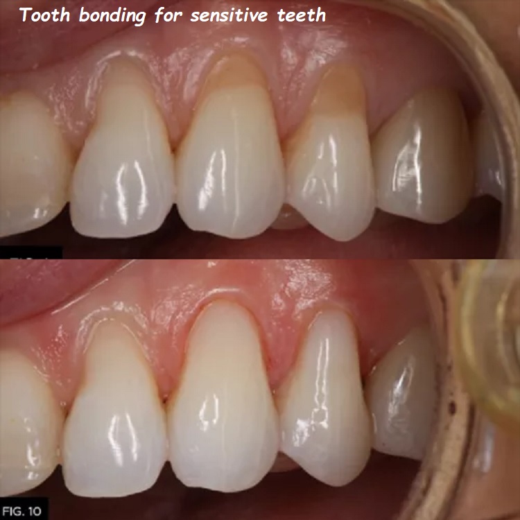 Tooth bonding for sensitive teeth