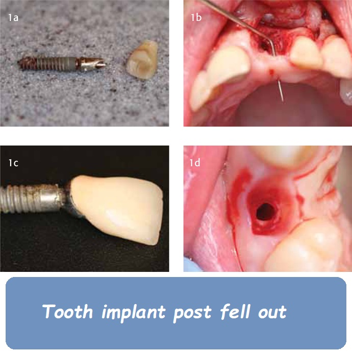 Tooth implant post fell out