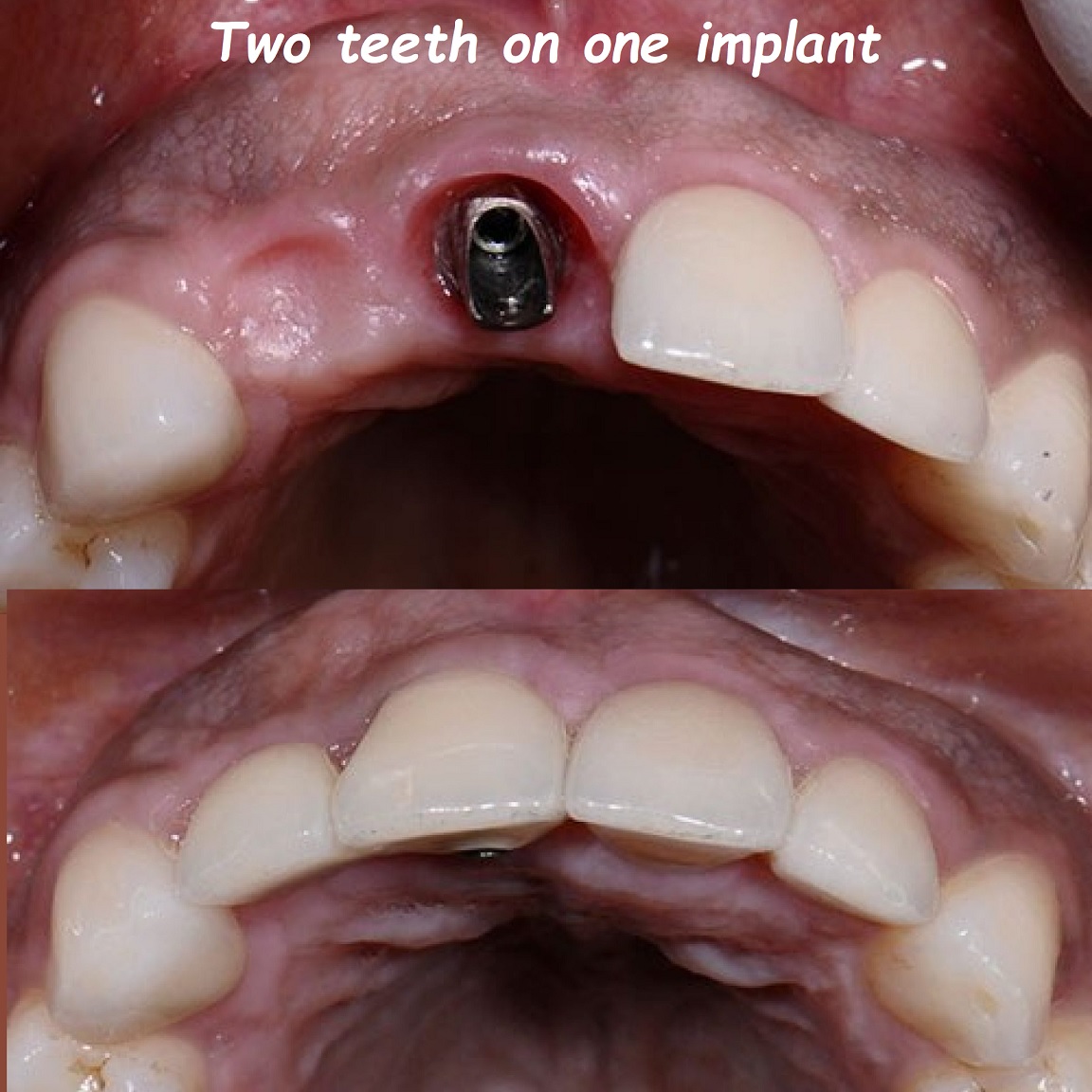 Two teeth on one implant