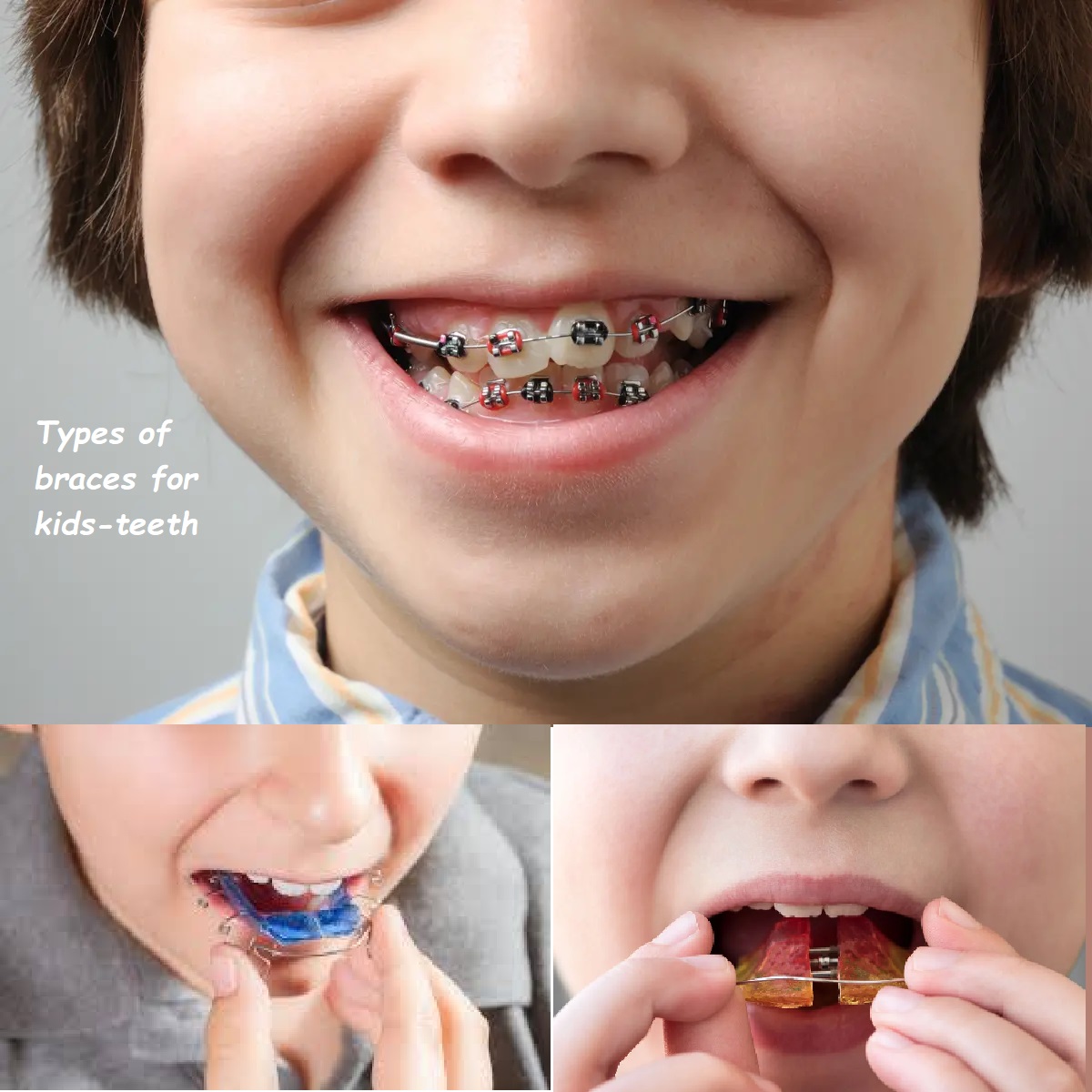 Types of braces for kids-teeth