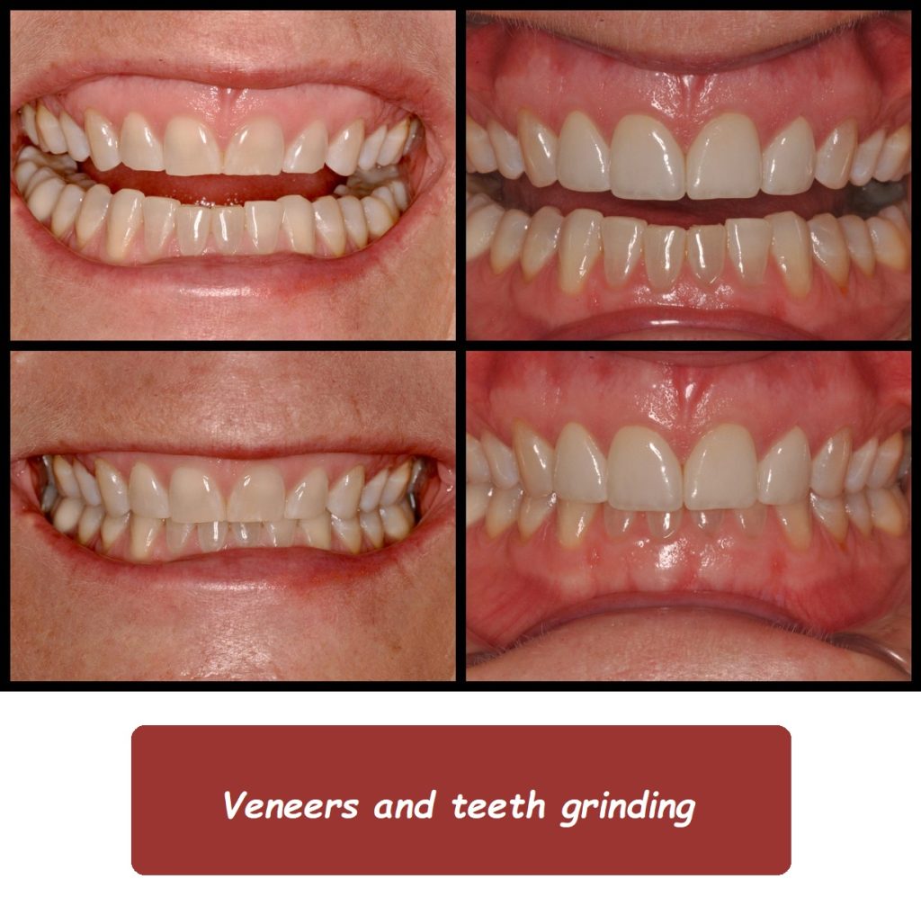 Veneers and teeth grinding