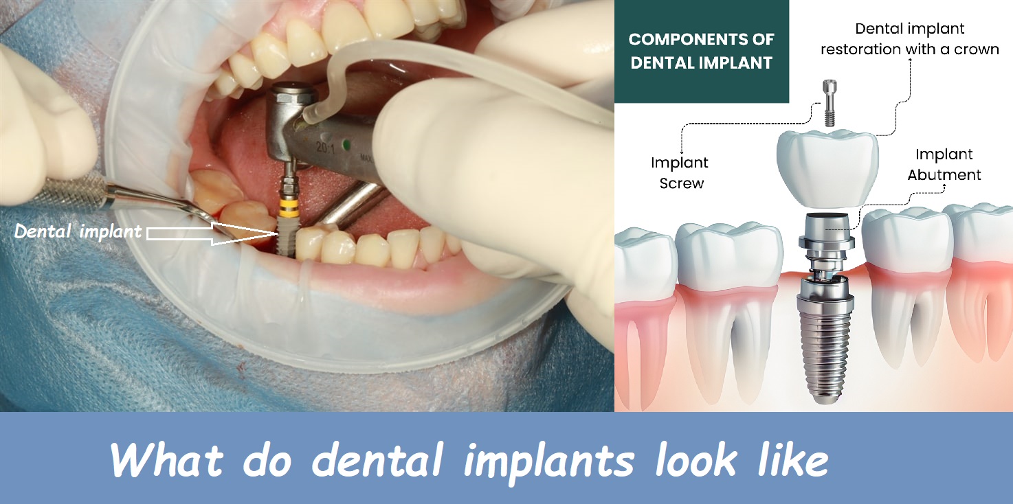 What do dental implants look like