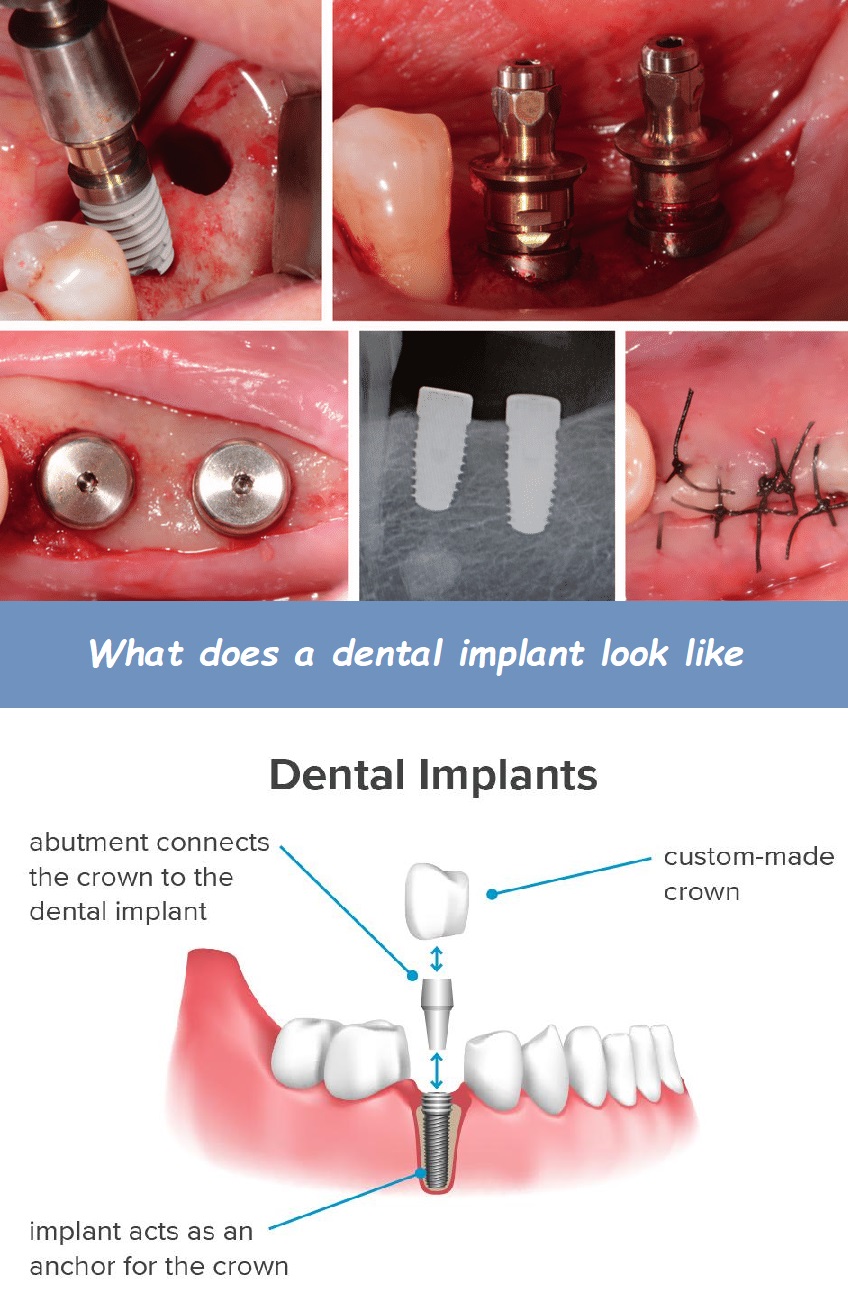 What does a dental implant look like