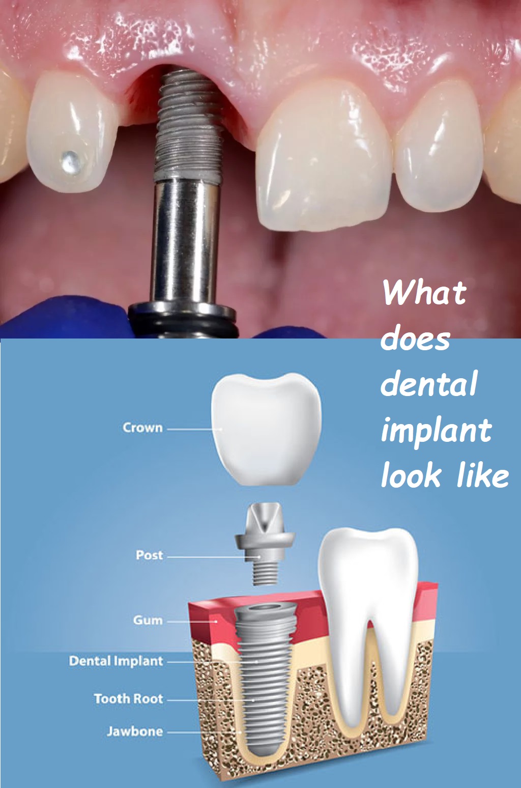 What does dental implant look like