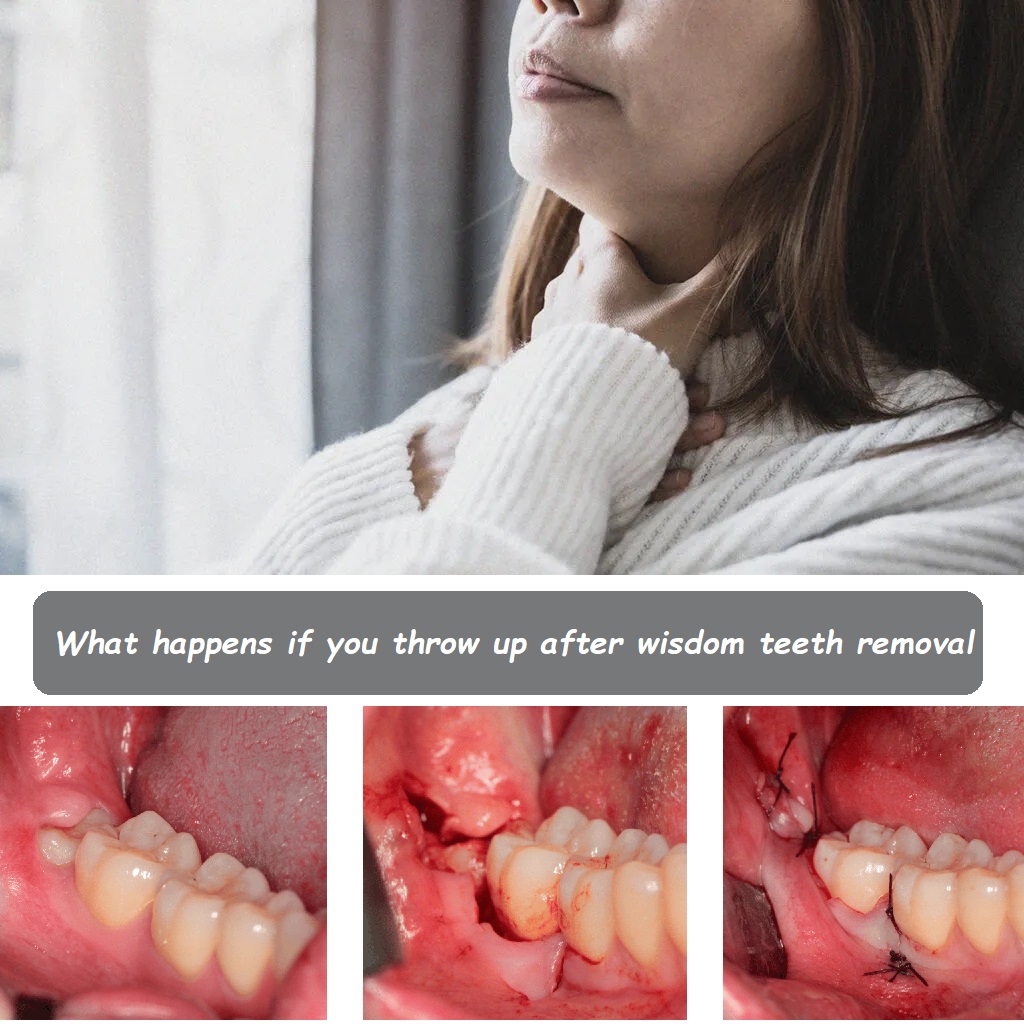 What happens if you throw up after wisdom teeth removal